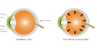 glaucoma